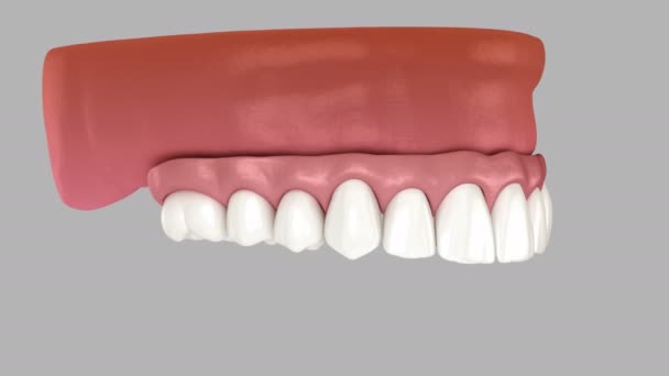 Herausnehmbare Prothese Die Von Vier Implantaten Unterstützt Wird Zahnärztliche Animation — Stockvideo