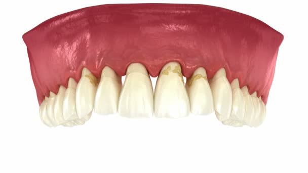 歯周炎や動力学のガムの不況 歯が失われます 歯科用3Dアニメーション — ストック動画