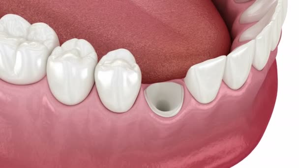 Стоматологічна Вкладка Штифта Пні Канановому Зубі Медично Точна Стоматологічна Анімація — стокове відео