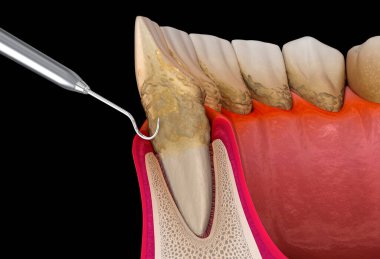 Ağız temizliği: Ölçekleme ve kök planlama (geleneksel periodontal terapi). İnsan diş tedavisinin tıbbi açıdan doğru üç boyutlu çizimi