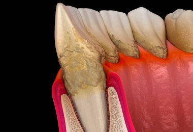 Periodontit aşaması 1, sakız durgunluğu, tartar. Tıbbi olarak doğru 3B illüstrasyon
