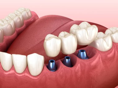 3 implantın üzerine 3 diş yerleştirme - kavram. İnsan dişlerinin ve takma dişlerinin 3 boyutlu çizimi