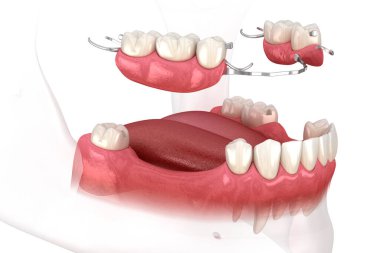 Çıkarılabilir kısmi takma diş, çene protezi. Medikal olarak protodontik konseptin 3 boyutlu çizimi