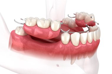 Çıkarılabilir kısmi takma diş, çene protezi. Medikal olarak protodontik konseptin 3 boyutlu çizimi
