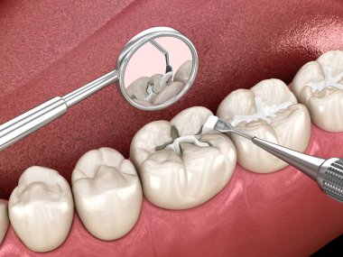 Diş dolgusu ile azı dişi yırtılması. Tıbbi olarak doğru diş 3D illüstrasyon.