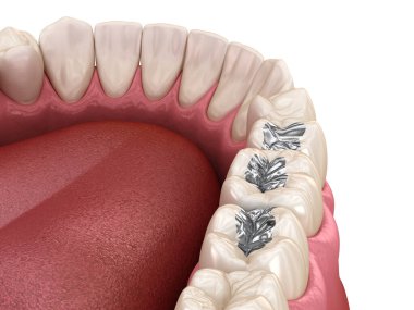Amalgam restorasyonu. Diş konseptinin tıbben doğru 3 boyutlu animasyonu