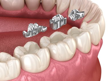 Amalgam restorasyonu. Diş konseptinin tıbben doğru 3 boyutlu animasyonu