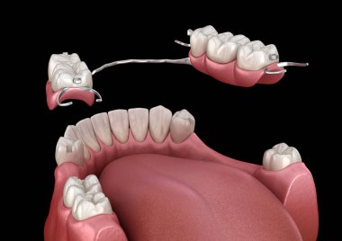 Çıkarılabilir kısmi takma diş, çene protezi. Medikal olarak protodontik konseptin 3 boyutlu çizimi