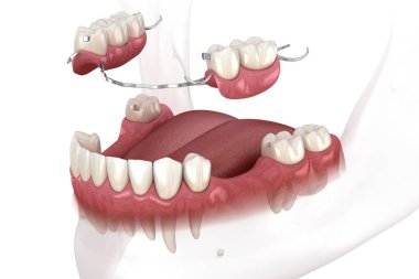 Çıkarılabilir kısmi takma diş, çene protezi. Medikal olarak protodontik konseptin 3 boyutlu çizimi