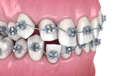 Anormal diş pozisyonu ve metal diş telleriyle düzeltme. Tıbbi olarak doğru olan 3 boyutlu diş illüstrasyonu