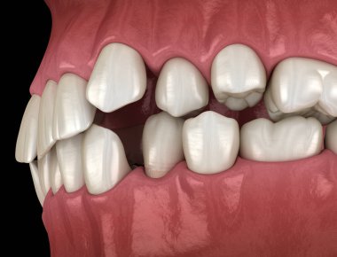 Aşırı kalabalık dişler, anormal diş tıkanıklığı. Tıbbi olarak doğru diş 3D illüstrasyon