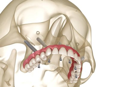 Elmacık kemiği implantları tarafından desteklenen Maxillary protezi. İnsan dişlerinin ve protezlerinin tıbbi açıdan doğru üç boyutlu çizimi