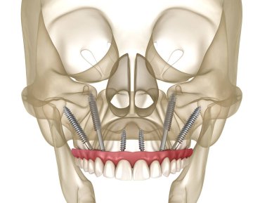 Elmacık kemiği implantları tarafından desteklenen Maxillary protezi. İnsan dişlerinin ve protezlerinin tıbbi açıdan doğru üç boyutlu çizimi