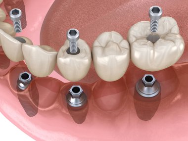 Çikletli çene protezi. Hepsi de implantlarla desteklenen 6 sistemde. İnsan dişleri ve protez kavramının tıbben doğru üç boyutlu çizimi