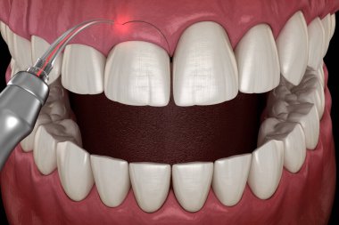 Lazerle Gingivectomi ameliyatı. Tıbbi olarak doğru diş 3D illüstrasyon