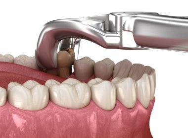 Azı dişinin alınması bakteriler tarafından zarar görmüş. Tıbbi olarak doğru diş 3D illüstrasyon.