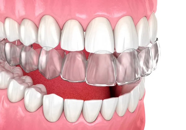 ブレースや目に見えない家臣を調査する 医学的に正確な歯科3Dイラスト — ストック写真