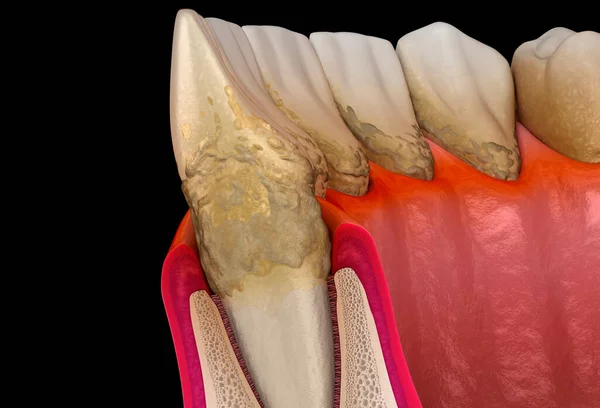 Parodontitis Stadium Zahnfleischrezession Zahnstein Medizinisch Korrekte Darstellung — Stockfoto