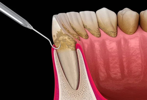 Higiene Oral Escalonamento Alisamento Radicular Terapia Periodontal Convencional Ilustração Medicamente — Fotografia de Stock