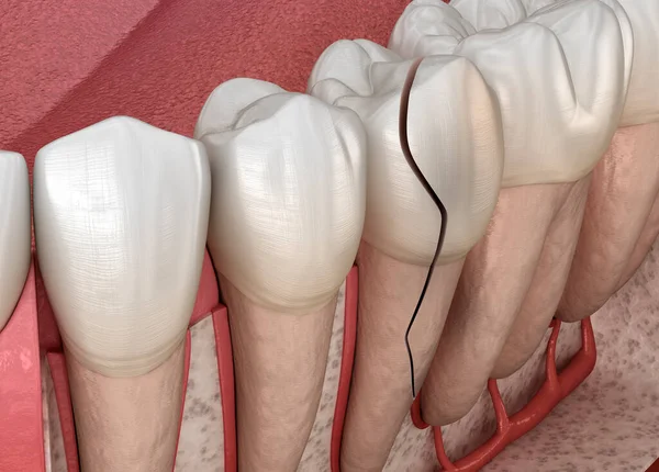 Σπασμένο Δόντι Διαλυμένο Ιατρικά Ακριβής Τρισδιάστατη Απεικόνιση — Φωτογραφία Αρχείου