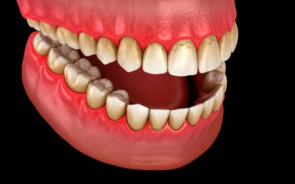 焦油和杆菌牙菌斑 下巴发炎 医学上准确的人类牙齿治疗三维图像 — 图库照片