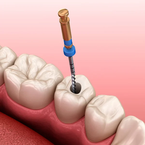Endodontický Kořenový Kanálový Léčebný Proces Lékařsky Přesná Zubní Ilustrace — Stock fotografie