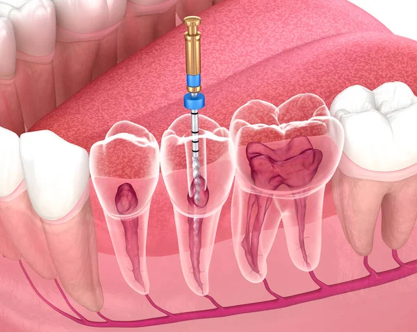 Processo Trattamento Endodontico Del Canale Radicolare Illustrazione Del Dente Clinicamente — Foto Stock