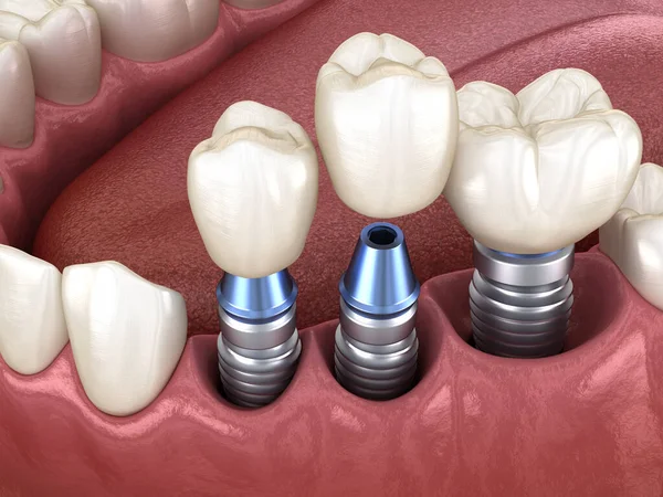 3つのインプラントの上に3つの歯冠の配置 人間の歯や入れ歯の3Dイラスト — ストック写真