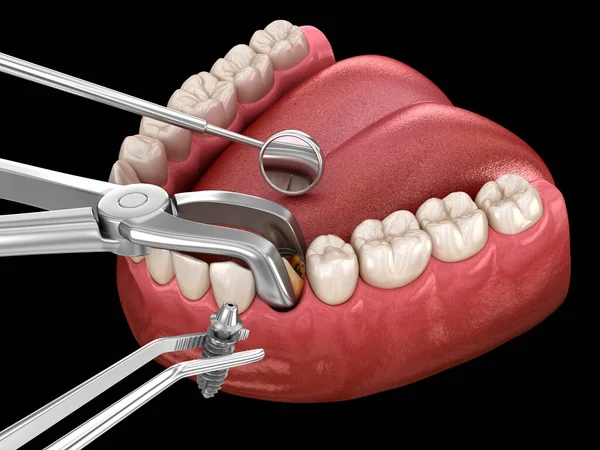 取出和植入 复杂的直接手术 牙科治疗的医学上准确的3D图像 — 图库照片
