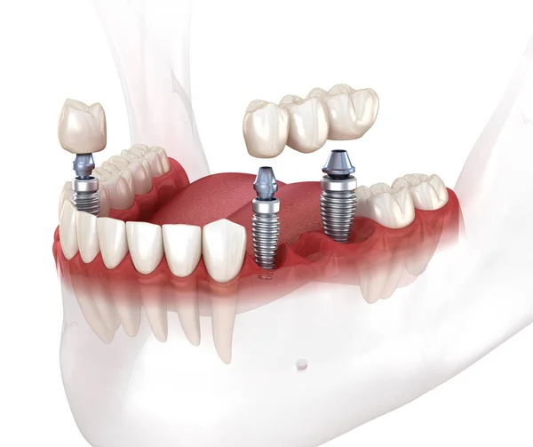 牙桥和冠放置在植入物之上 牙科3D图解概念 — 图库照片