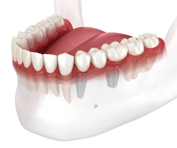 Zubní Můstek Umístění Koruny Nad Implantáty Zubní Ilustrační Koncept — Stock fotografie