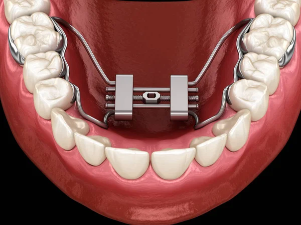 Expansion Palatine Rapide Illustration Dentaire Médicalement Précise — Photo