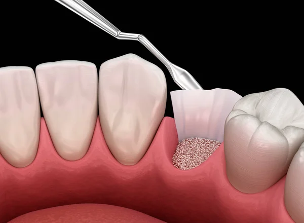 Cirugía Aumento Añadir Hueso Después Extracción Dental Ilustración — Foto de Stock