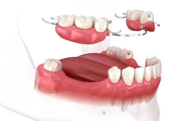 切除可能な部分的義歯 顎前義歯 義歯の概念の医学的に正確な3Dイラスト — ストック写真