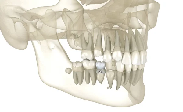恒牙爆发 丧失基牙 医学上准确的牙科3D图像 — 图库照片