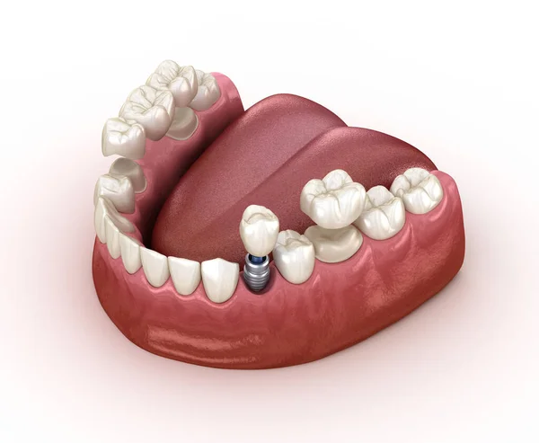假牙修复与种植体冠和桥 医学上准确的三维图形牙齿概念 — 图库照片