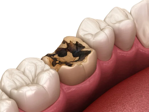 Dente Danneggiato Dalla Carie Illustrazione Del Dente Clinicamente Accurata — Foto Stock
