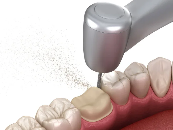 Prämolare Präparation Für Die Platzierung Der Zahnkrone Medizinisch Korrekte Illustration — Stockfoto