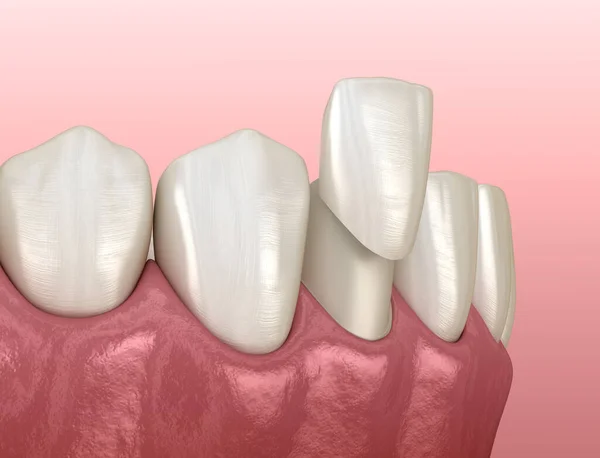 Процедура Розміщення Шпону Медично Точна Ілюстрація Зуба — стокове фото