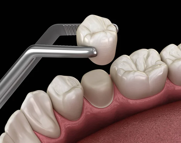 Przygotowany Ząb Przedtrzonowy Umieszczenie Korony Dentystycznej Medycznie Dokładna Ilustracja — Zdjęcie stockowe