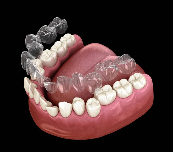 异形矫正器或隐形器可以矫正咬痕 医学上准确的3D图像 — 图库照片