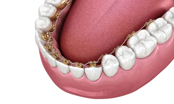 Denti Sani Con Bretelle Oro Illustrazione Dentale — Foto Stock
