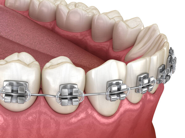 Metal braces tretament, macro view. Medically accurate dental 3D illustration