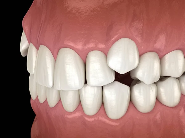 Aufgetretene Schneidezähne Überfüllte Zähne Medizinisch Korrekte Darstellung Eines Abnormen Zahnverschlusses — Stockfoto