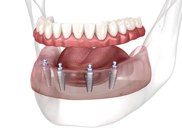 可摘除的下颌骨假体全部在4个系统上 由植入物支持 医学上准确的人类牙齿和假牙概念三维图像 — 图库照片