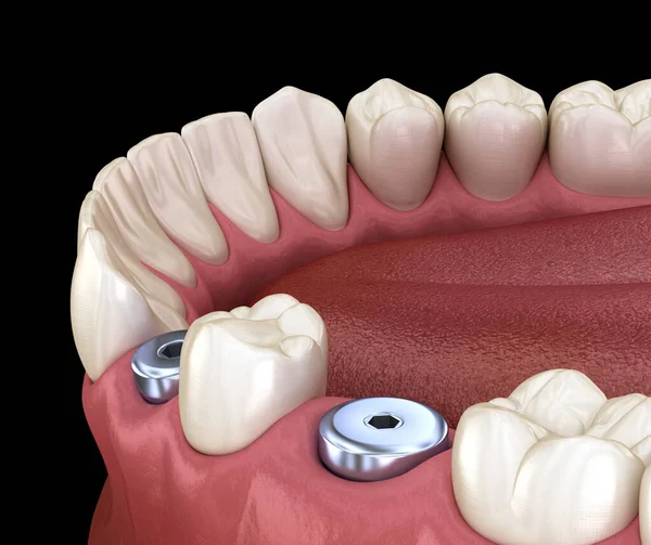 カバーネジ 一時インプラントのアバットメント 人間の歯と入れ歯の概念の医学的に正確な3Dイラスト — ストック写真