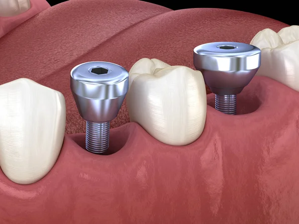 Täckskruv Tillfälligt Implantat Abutment Medicinskt Korrekt Illustration Mänskliga Tänder Och — Stockfoto