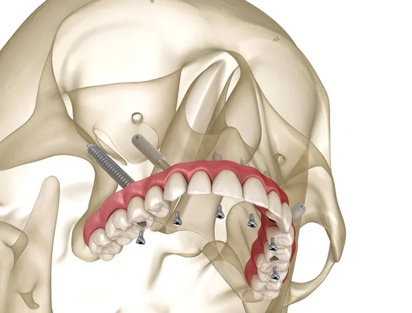 Maxilární Protéza Podporovaná Zygomatickými Implantáty Lékařsky Přesná Ilustrace Lidských Zubů — Stock fotografie