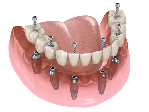 ガムで顎関節のプロテーゼインプラントでサポートされている6つのシステムのすべて 人間の歯と入れ歯の概念の医学的に正確な3Dイラスト — ストック写真