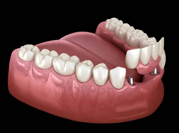インプラントで支えられた正面歯の橋 歯科概念の医学的に正確な3Dアニメーション — ストック写真